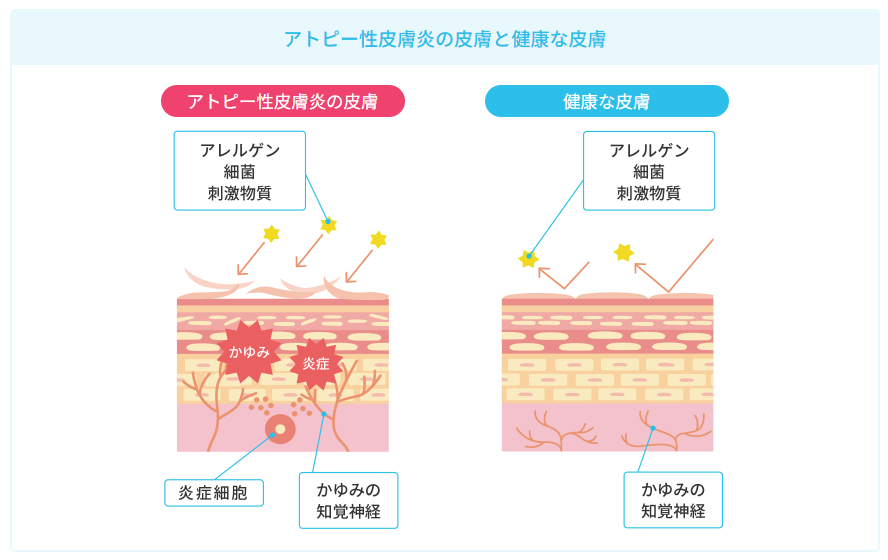 アトピー性皮膚炎とは